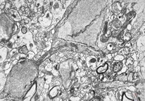 F,15y. | infantile neuroaxonal dystrophy (Seitelberger)